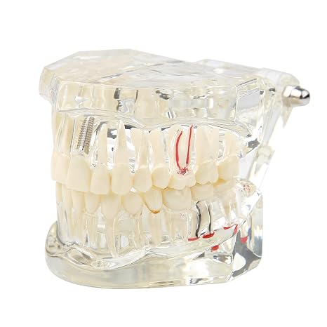Dental Implant Teeth Model Transparent Disease Teeth Model Clear
